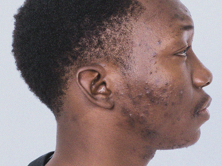 Ways To Treat Acne Without Harming The Skin The Ghana Report