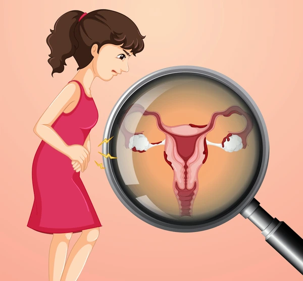 woman-ovarian-cancer-illustration-600nw-1125078344