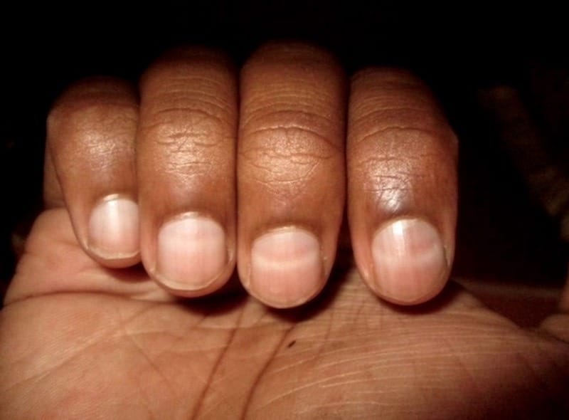 This is what white marks on fingernails say about your health
