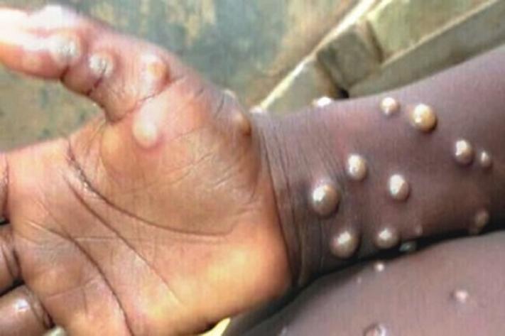 Monkeypox-Virus-Causes-Symptoms-Diagnosis-treatment-DR-Qaisar-Ahmed-Homeopathic-Best doctor in Pakistan-Dr Qaisar Ahmed-Al Haytham Clinic-Risalpur-KPK
