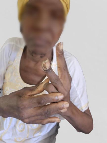 (Caption) Ms Abigail Amegavie shows the remnants of her legs